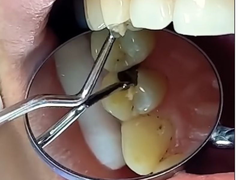 stomatolog gleda karijes na zubu